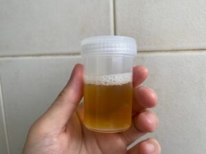 What Causes Protein in Urine? Understanding the Key Factors